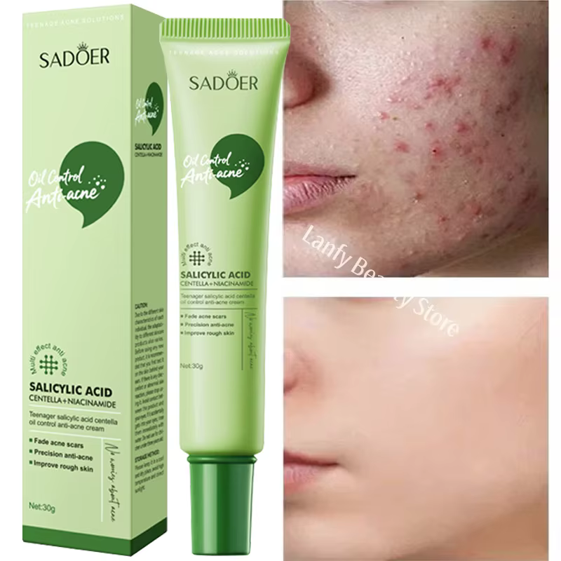 Crème Visage Traitement Acné à l'Acide Salicylique – Répare les Imperfections, Nettoie en Profondeur