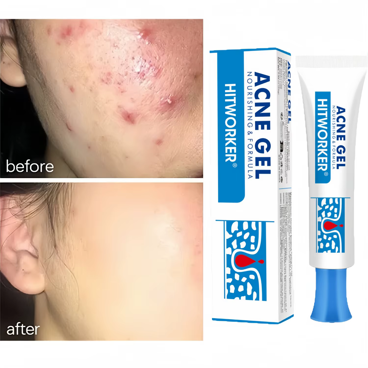 Crème anti-acné à l'acide salicylique, réparation des rougeurs et des boutons, nettoyage en profonde