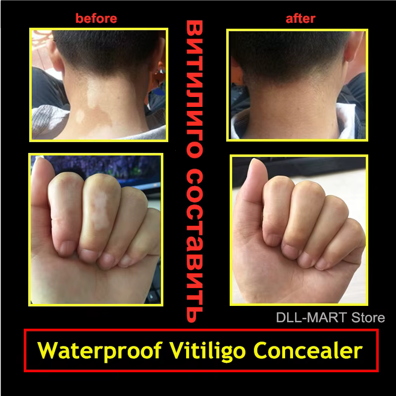 Couverture de Camouflage pour peau de Vitiligo