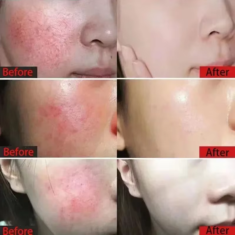 Crème Réparatrice Anti-Rougeurs Visage – Améliore la Peau Sensible et la Sécheresse – Hydratant Apaisant – Élimine la Rosacée – Cosmétiques Coréens