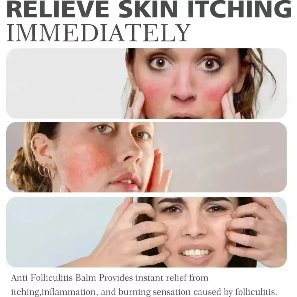 3ème crème Anti-acné efficace élimine les Nodules de la peau Pustules Cysts Papules points noirs hommes et femmes acné