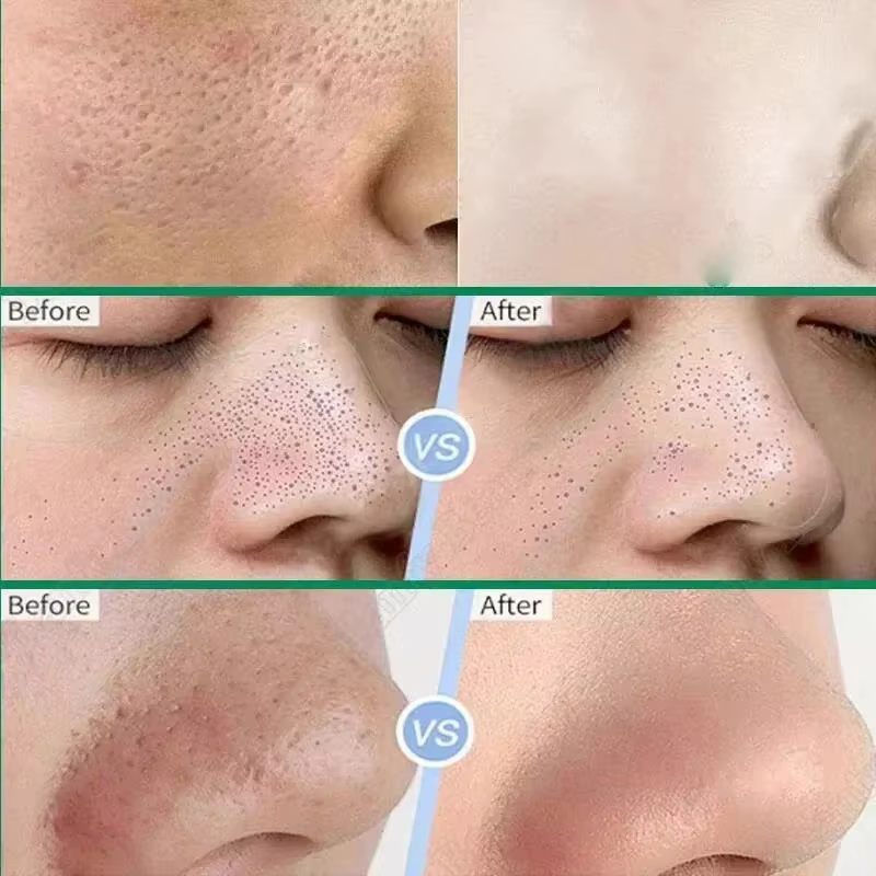 Masque rétrécissement des pores à l'acide salicylique