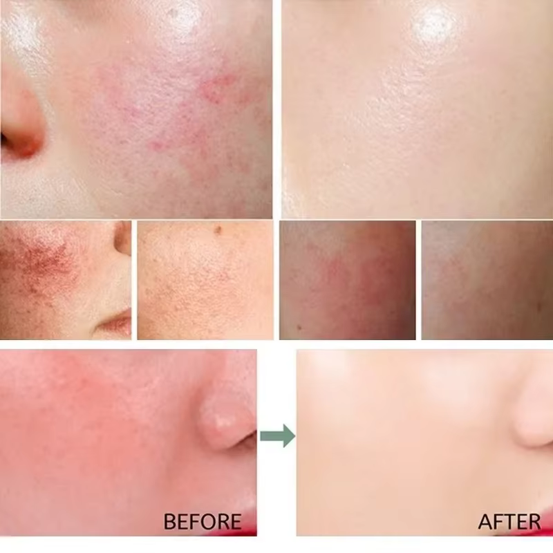 Masque Réparateur Anti-Rougeurs Visage – Améliore Rapidement la Peau Sensible et Sèche – Sérum Hydratant Apaisant – Élimine les Rougeurs et la Rosacée – Soin de Beauté