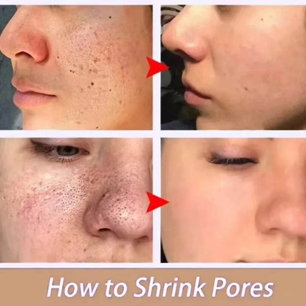 Sérum d'élimination des grands Pores