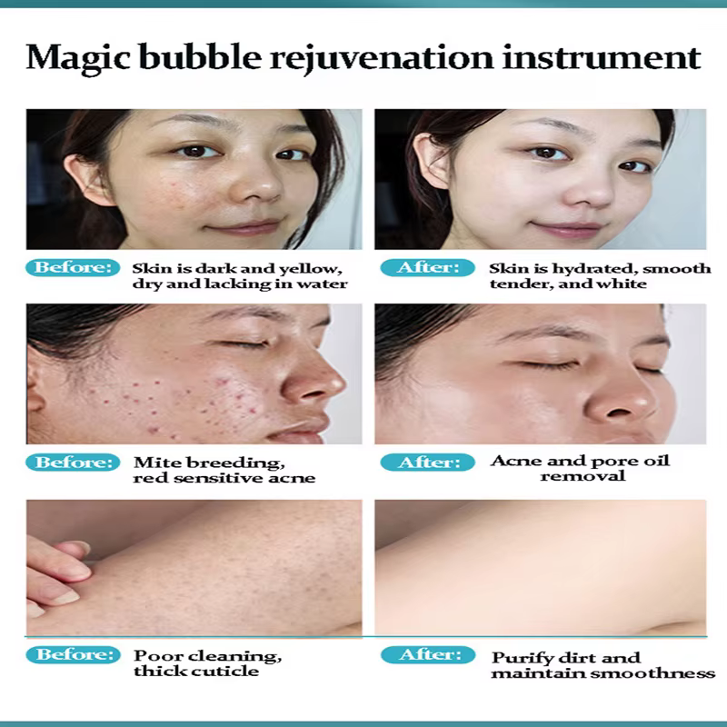 Solution magique d'oxygène actif d'eau de bulle de nettoyage de Rose pour la Machine automatique Instrument de beauté soins de la peau du visage livraison directe