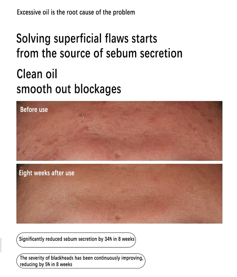 Sérum à la niacinamide 10% + zinc 1% 30 ml Contrôle du sébum Élimine l'acné et éclaircit les peaux grasses Exfoliant doux Essence à pores resserrés