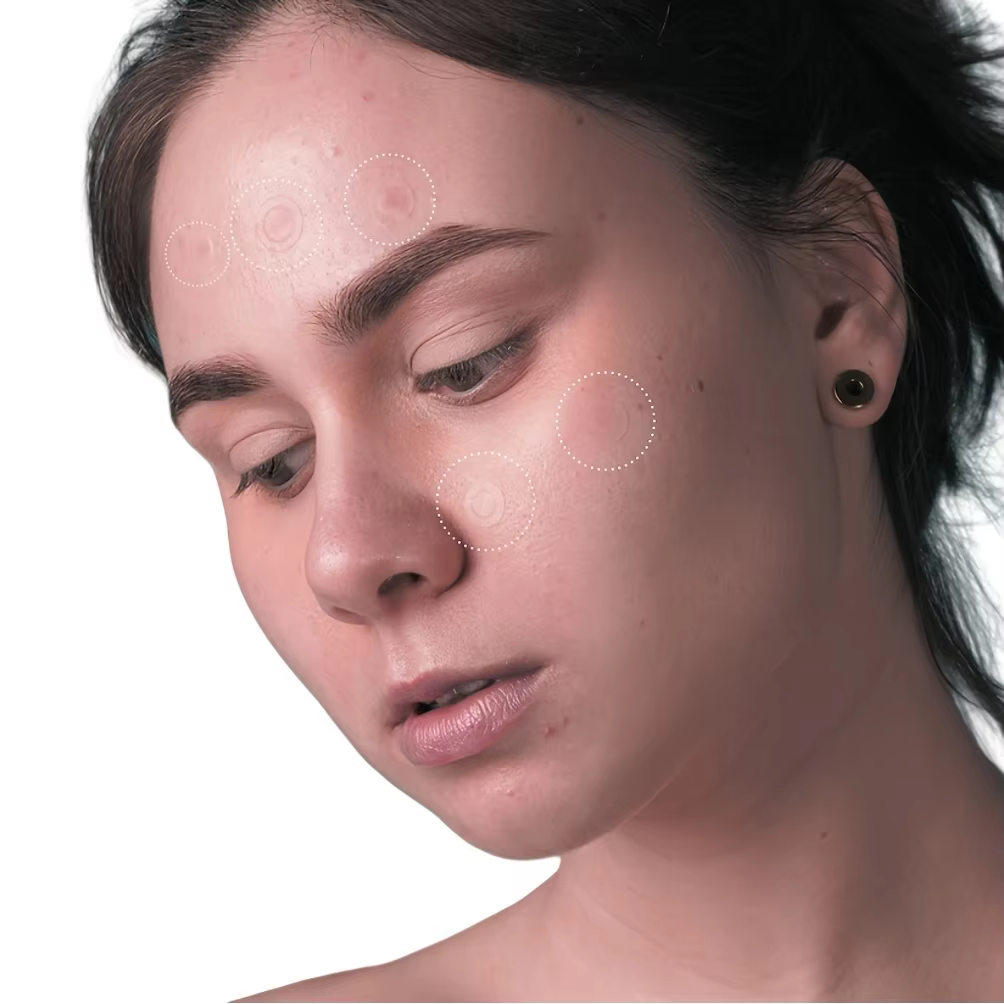 36 patchs hydrocolloïdes contre l'acné – Absorbant le Pus & Oil