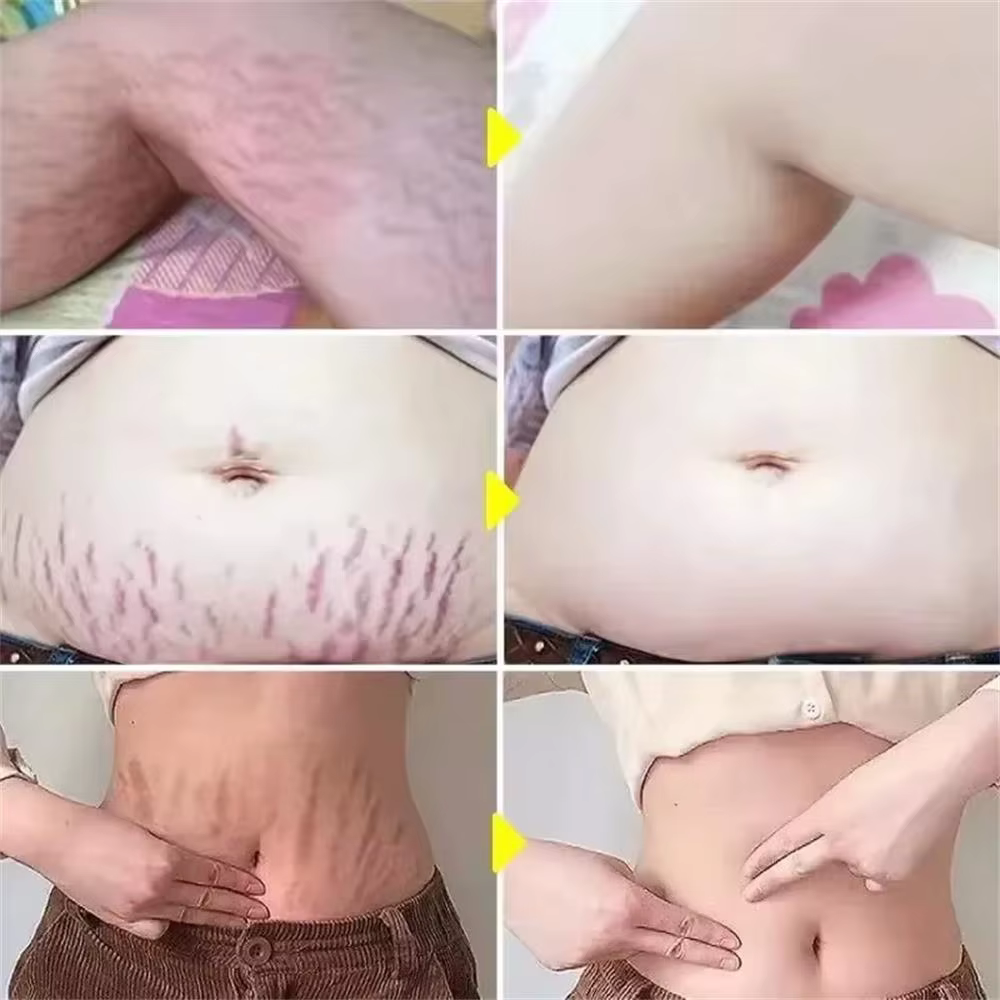 Crème anti-vergetures permanente 100g pour femmes enceintes