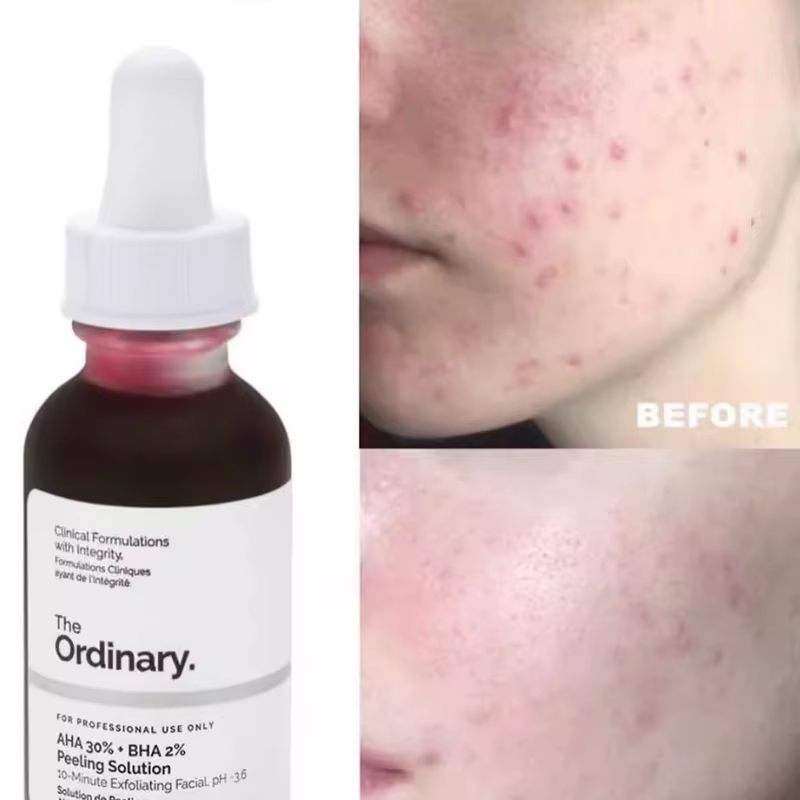 AHA 30% + BHA 2% Solution Peeling 30ml