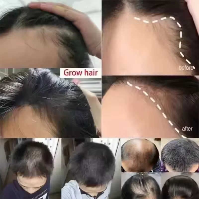 Crème de croissance des cheveux, Capsule essentielle pour une repousse rapide en 7 jours, Anti-chute de cheveux, réparation de la calvitie, traitement du cuir chevelu endommagé, pour femmes et hommes