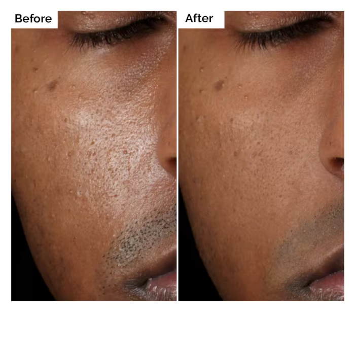 Sérum Solution Aloe 2% + NAG 2% 30 ml pour les marques post-acné améliore la texture de la peau