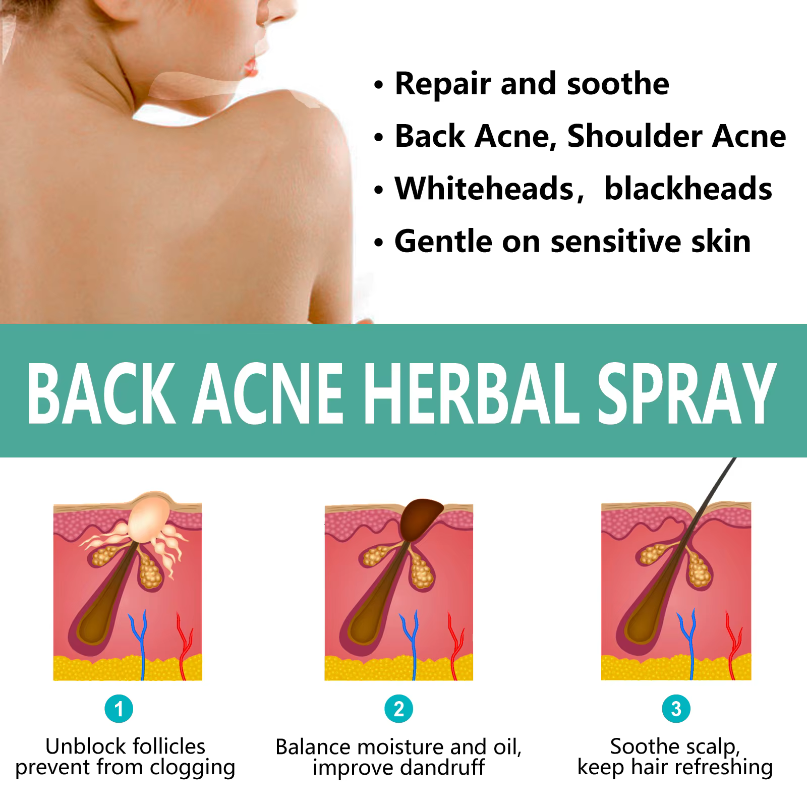 Spray dissolvant d'acné à base de plantes