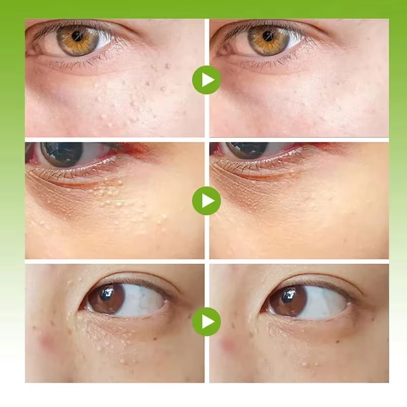 Dissolvant de granulés de graisse crème pour les yeux efficace élimine