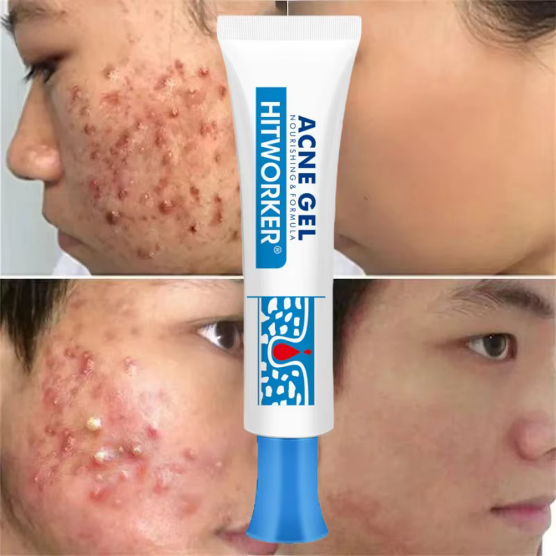 Crème anti-acné à l'acide salicylique