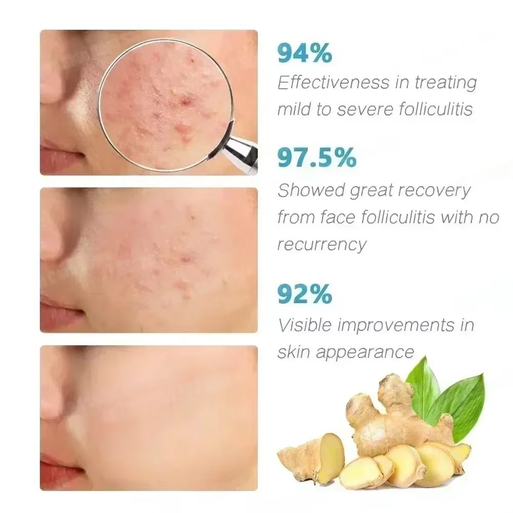 3ème crème Anti-acné efficace élimine les Nodules de la peau Pustules Cysts Papules points noirs hommes et femmes acné