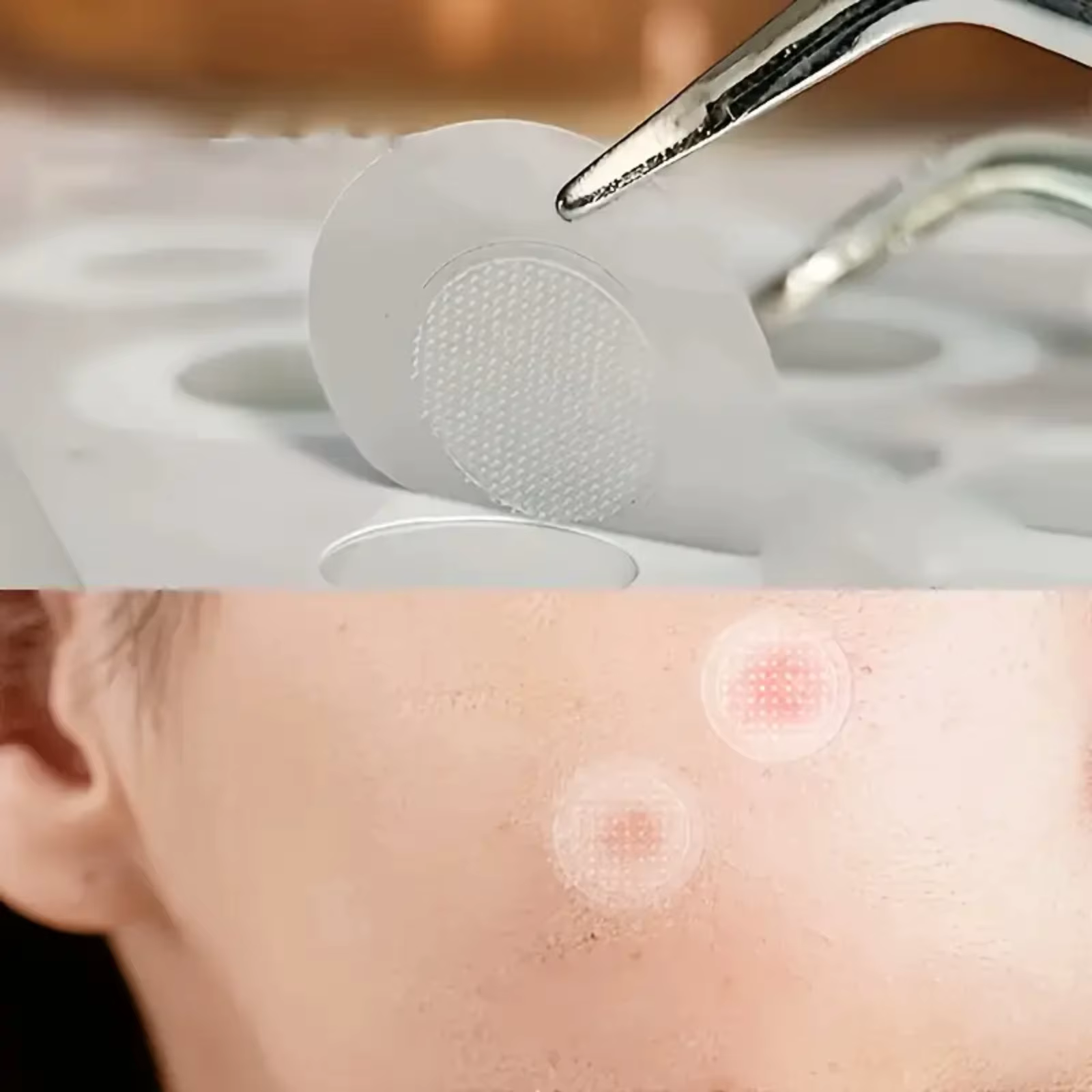 Autocollants hydrocolloïdes contre l'acné