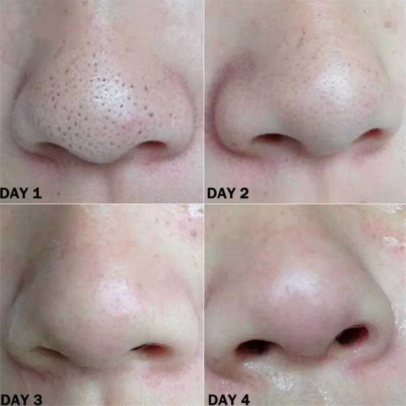 Nez points noirs dissolvant masque bandes nasales tête noire nez