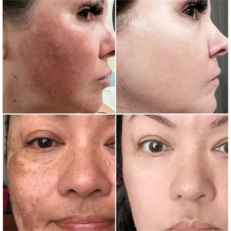 Crème blanchissante puissante anti-taches