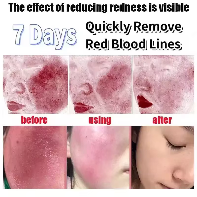 Crème réparatrice pour les rougeurs du visage