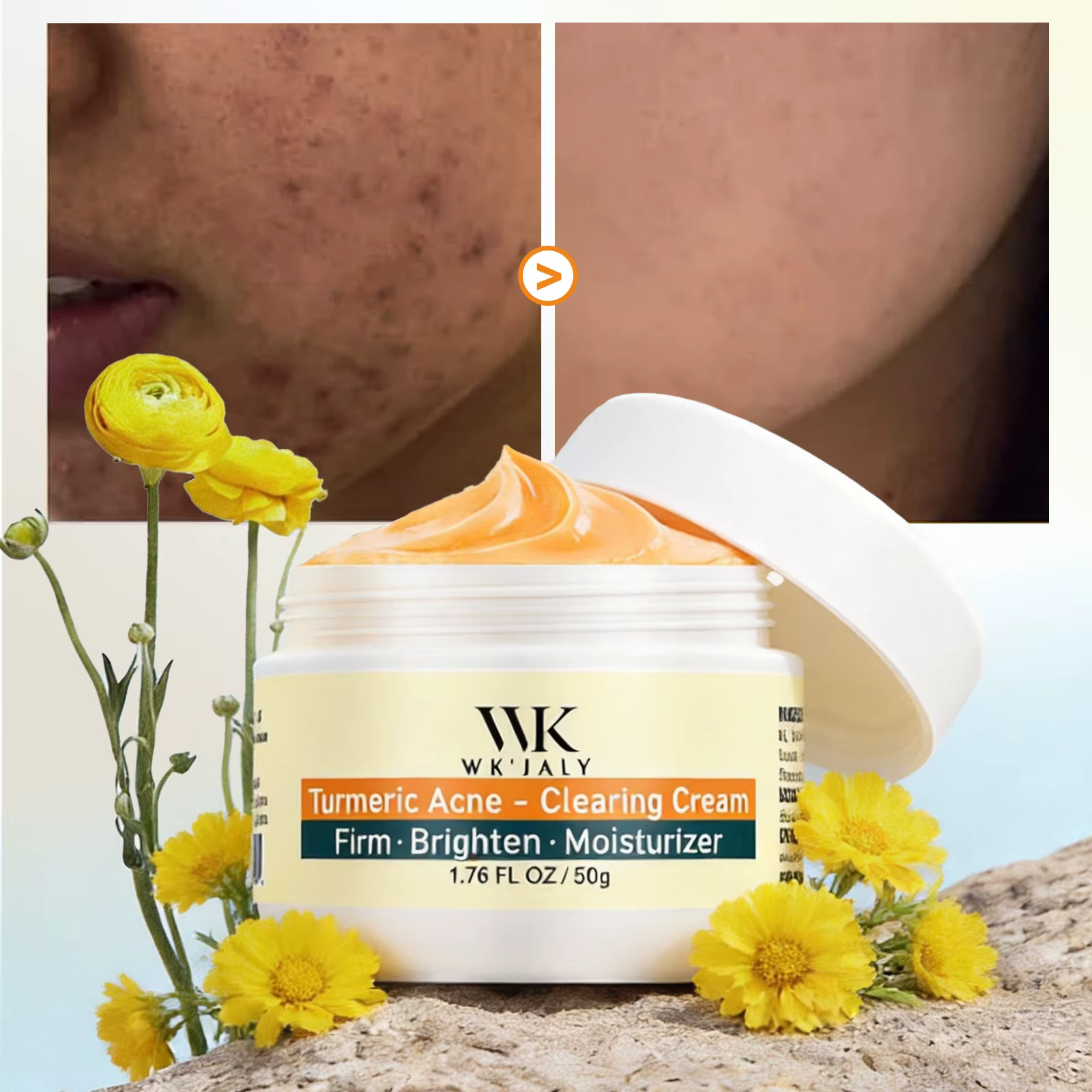 Crème faciale anti-acné au curcuma WK JALY