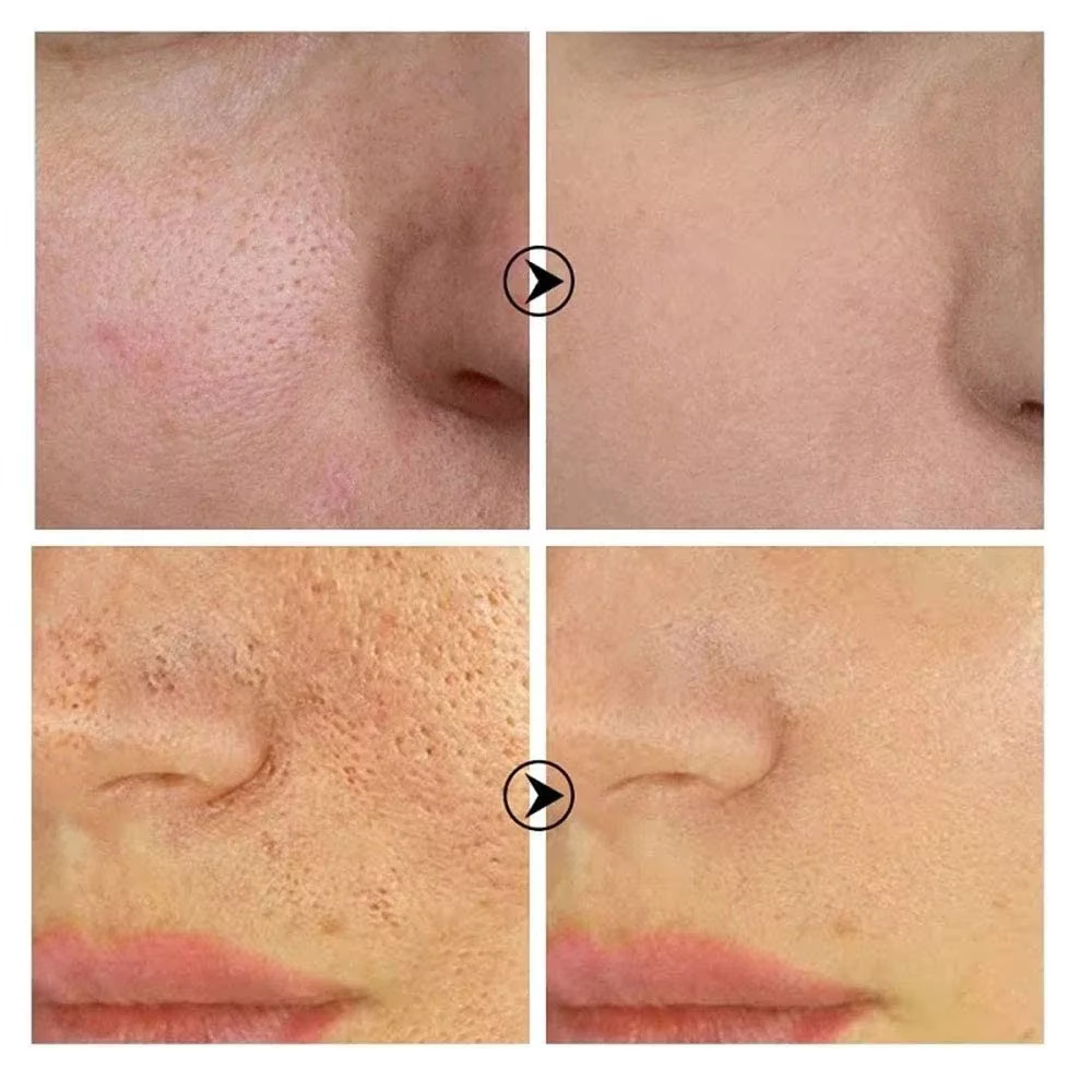 Skin Bergamo | Pore Refining Resurfacing