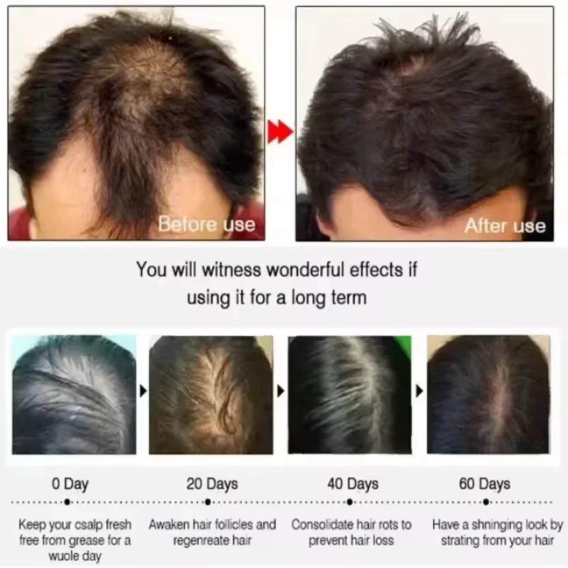 Crème de croissance des cheveux, Capsule essentielle pour une repousse rapide en 7 jours, Anti-chute de cheveux, réparation de la calvitie, traitement du cuir chevelu endommagé, pour femmes et hommes