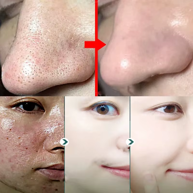 Crème de traitement à l'acide salicylique pour resserrer les pores