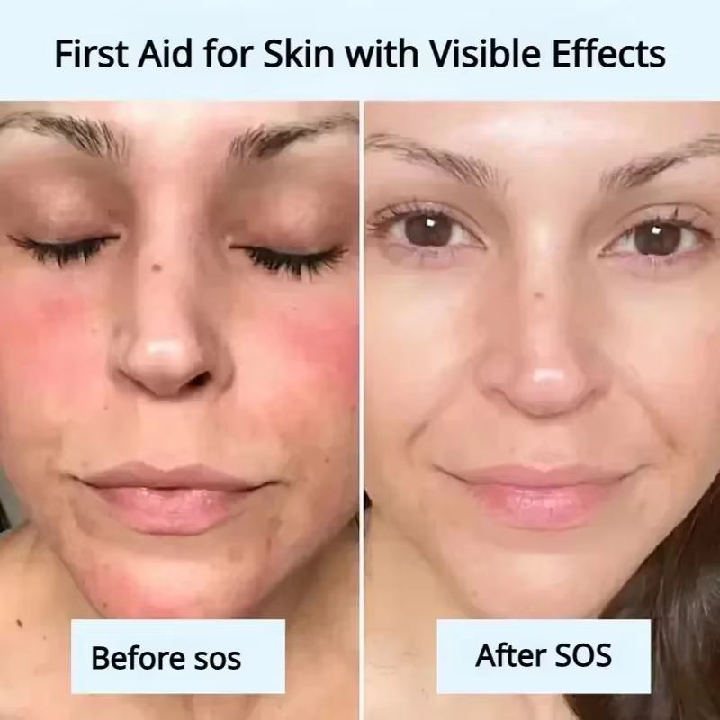 Masque Réparateur Anti-Rougeurs Visage – Améliore Rapidement la Peau Sensible et Sèche – Sérum Hydratant Apaisant – Élimine les Rougeurs et la Rosacée – Soin de Beauté
