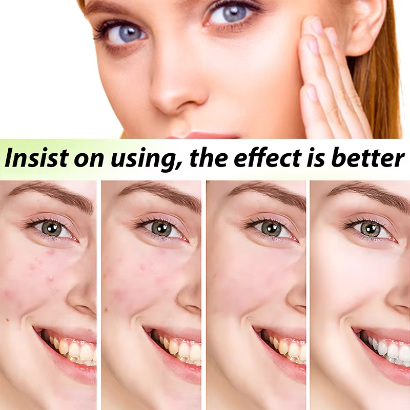 3ème crème Anti-acné efficace élimine les Nodules de la peau Pustules Cysts Papules points noirs hommes et femmes acné