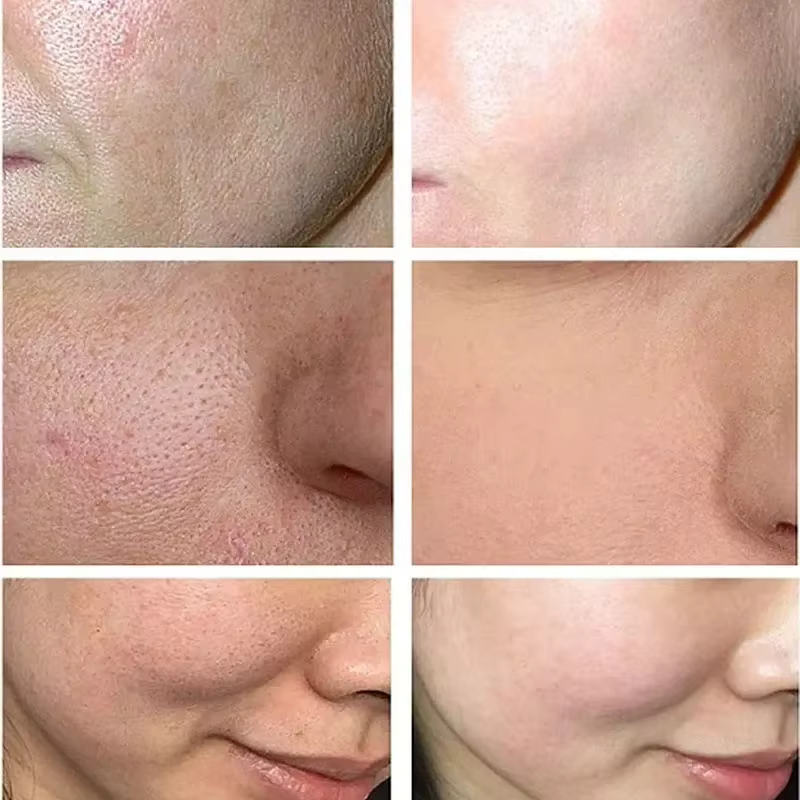 Crème de traitement à l'acide salicylique pour resserrer les pores