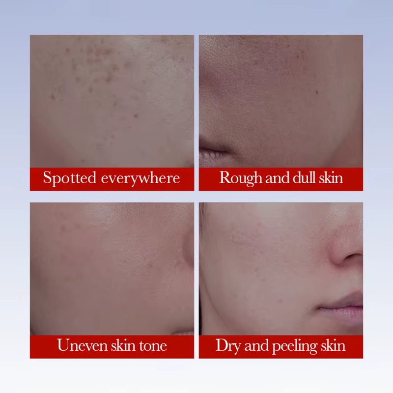 SADOER crème Anti taches de rousseur crèmes éclaircissantes pour le visage élimination