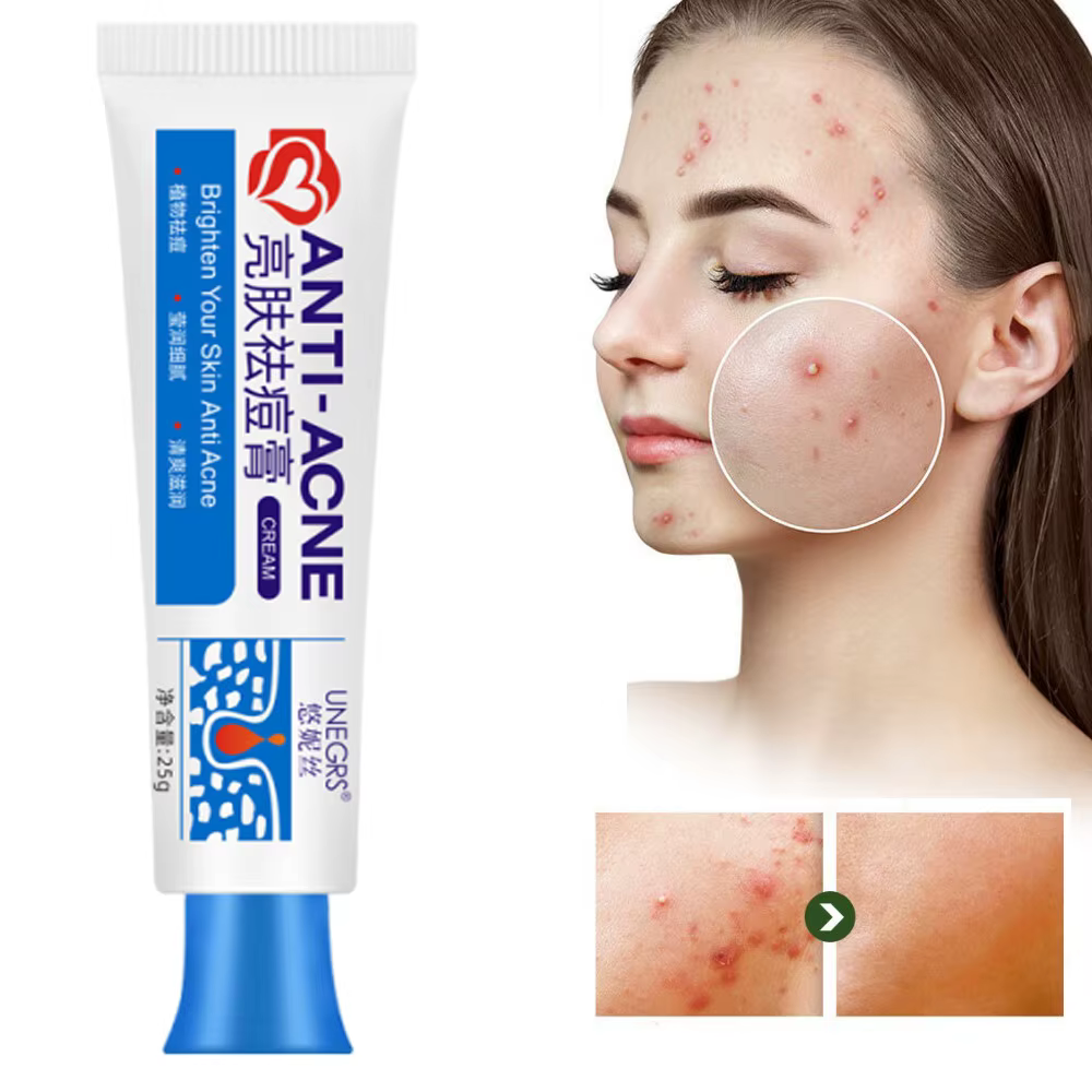 Crème Visage Anti-Acné à Base de Plantes