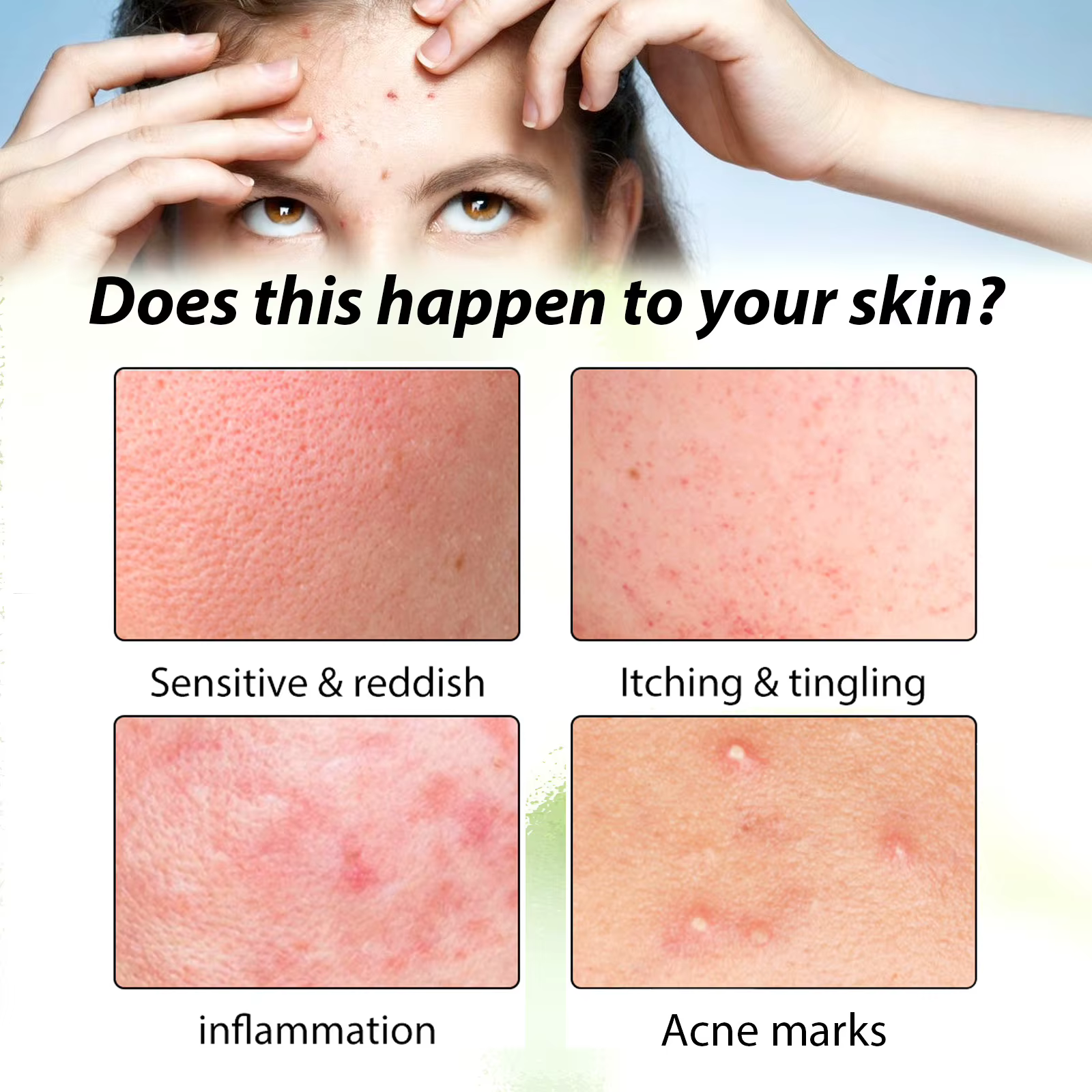 3ème crème Anti-acné efficace élimine les Nodules de la peau Pustules Cysts Papules points noirs hommes et femmes acné
