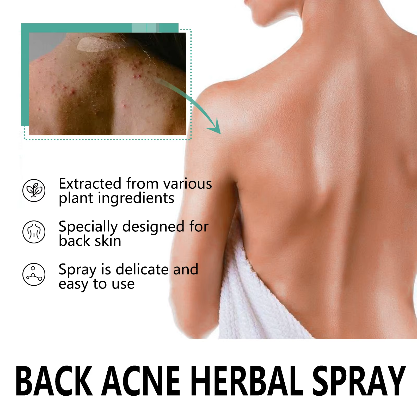 Spray dissolvant d'acné à base de plantes